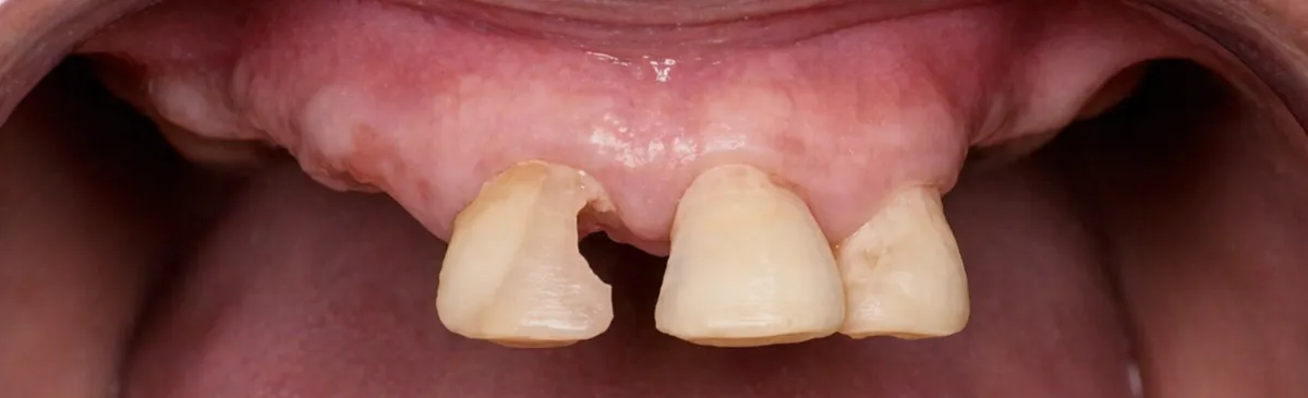 Before All-on-6 dental implants