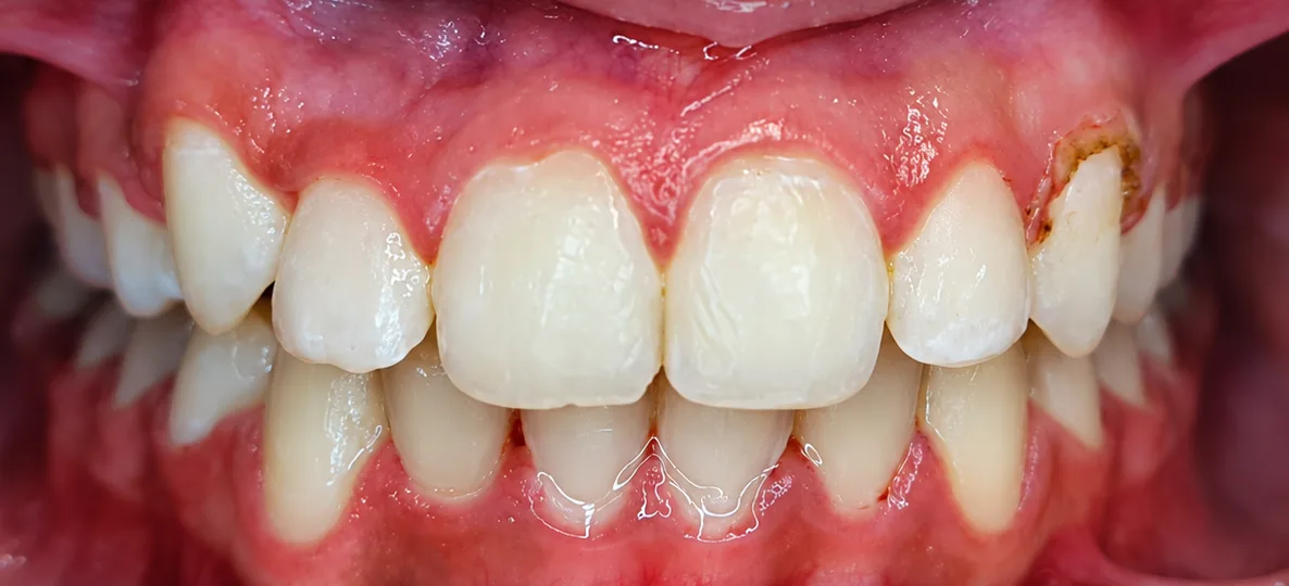 After Damon braces