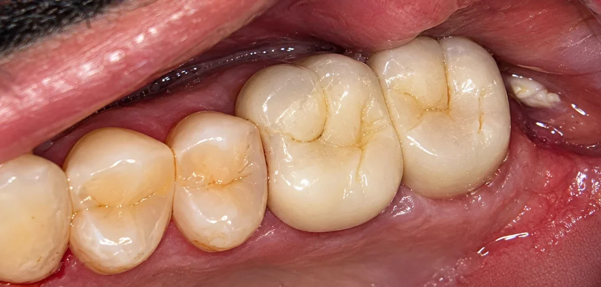 After DMLS crowns for back teeth
