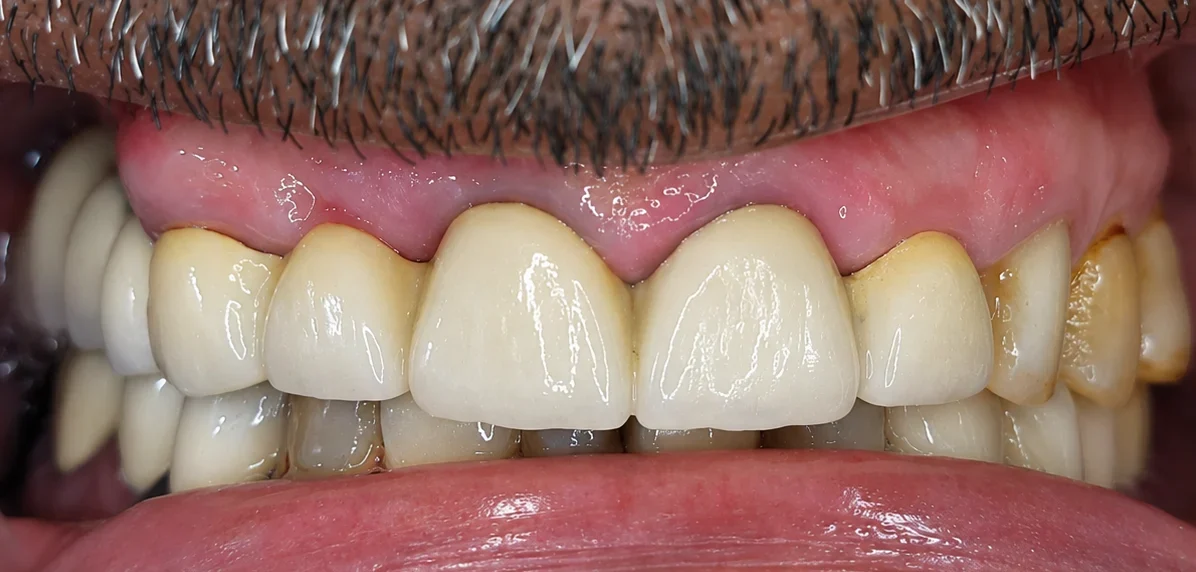 After DMLS bridge for front teeth