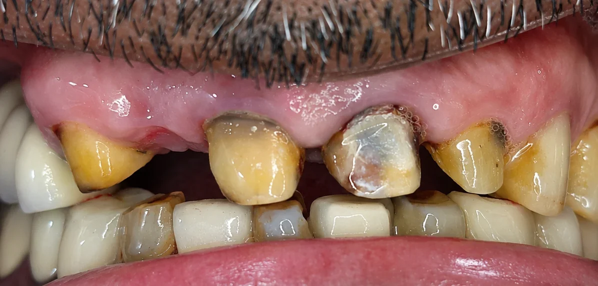Before DMLS bridge for front teeth