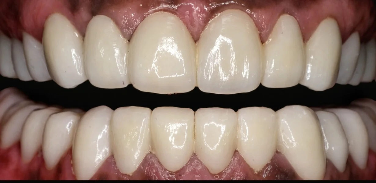 After Full mouth rehabilitation with zirconia crowns