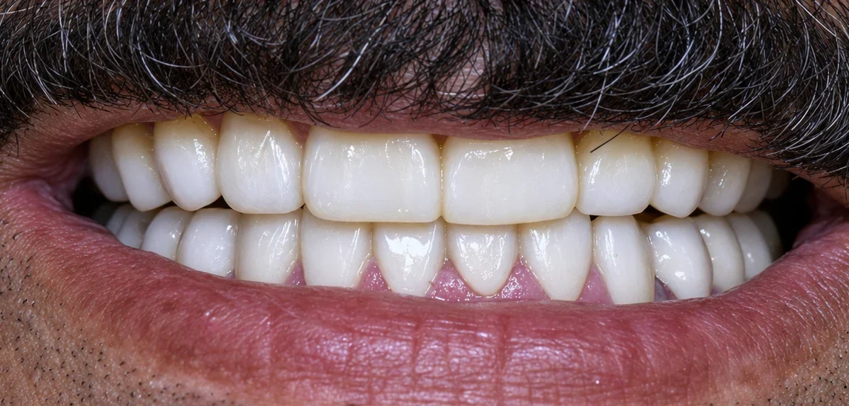 After Full mouth rehabilitation: zirconia crowns on both jaws