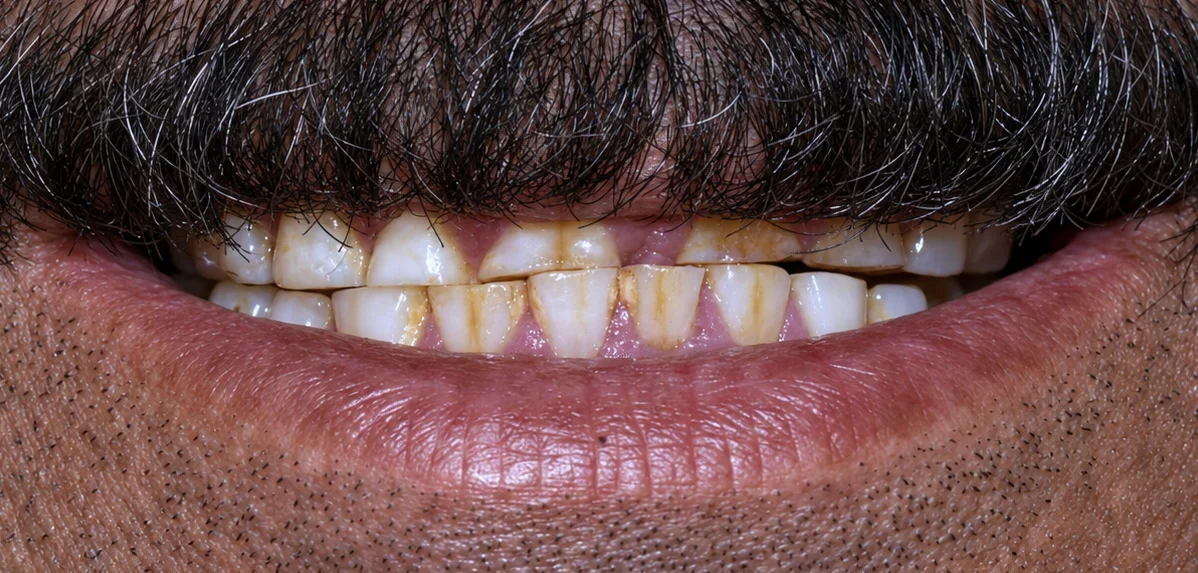 Before Full mouth rehabilitation: zirconia crowns on both jaws