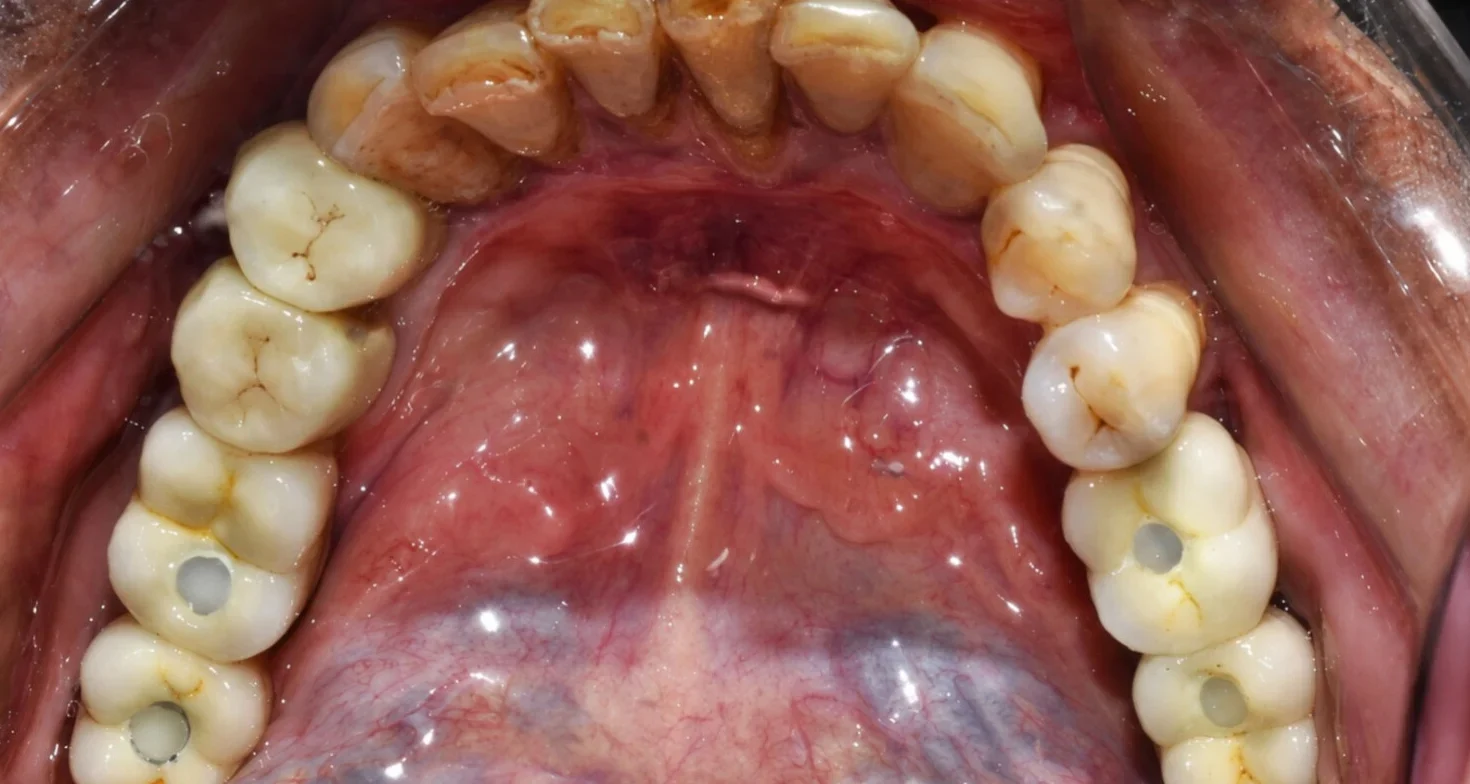 After Dental implants for missing back teeth