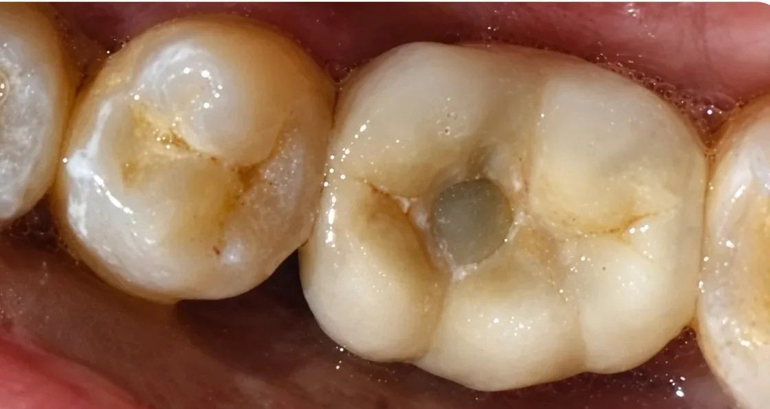 After Missing back tooth replaced with a dental implant