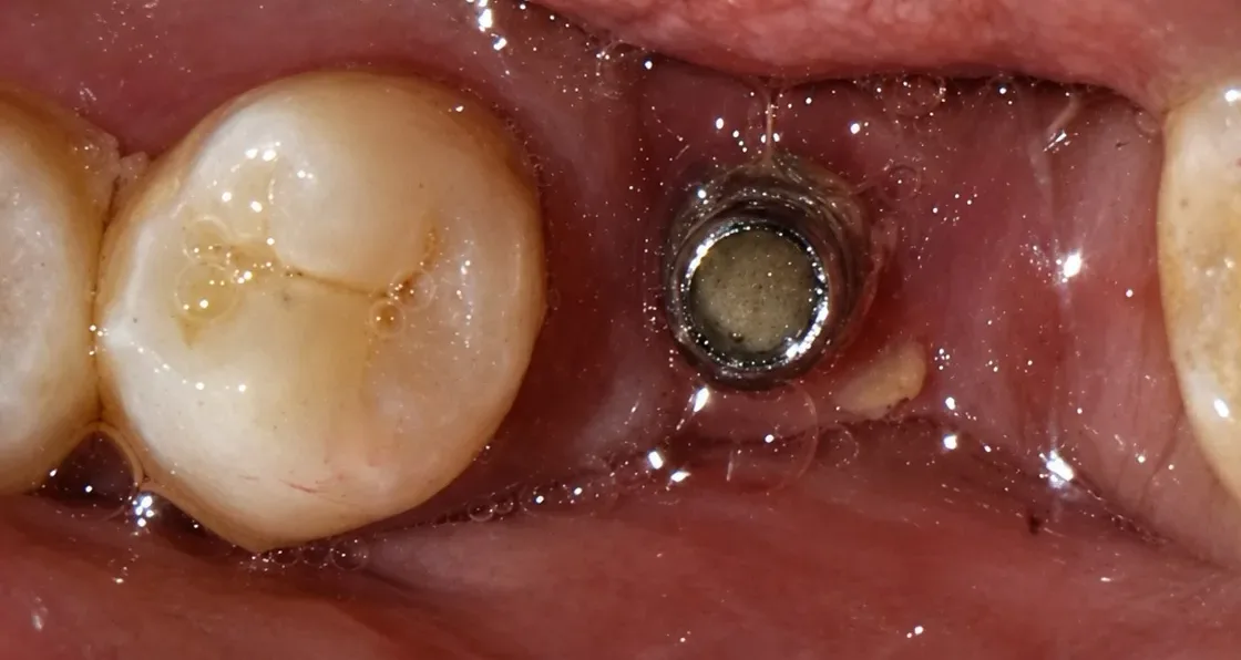 Before Missing back tooth replaced with a dental implant