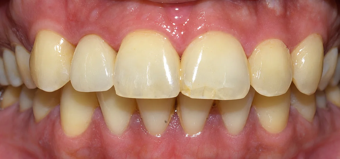 After Dental implant with zirconia crown