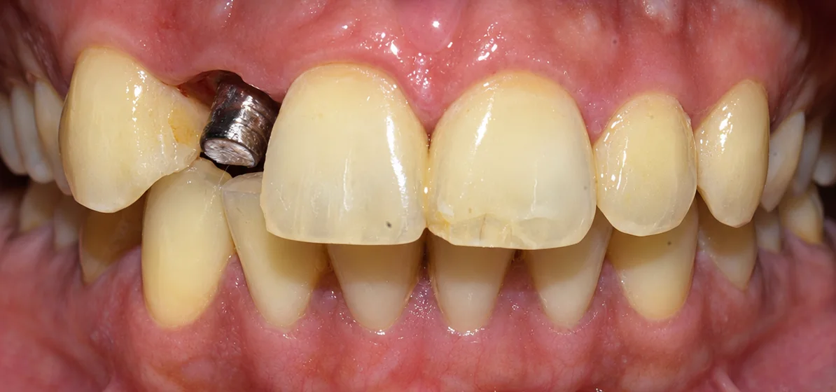 Before Dental implant with zirconia crown