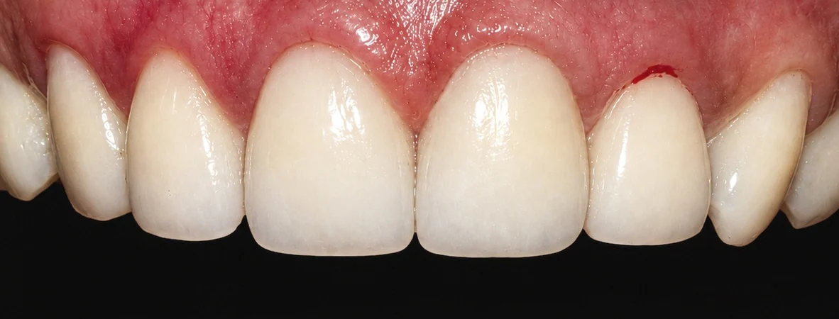 After E-max ceramic veneers