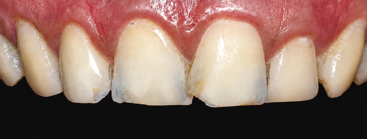 Before E-max ceramic veneers