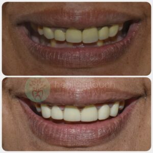 Complete Denture in Gurgaon