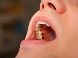 LINGUAL BRACES