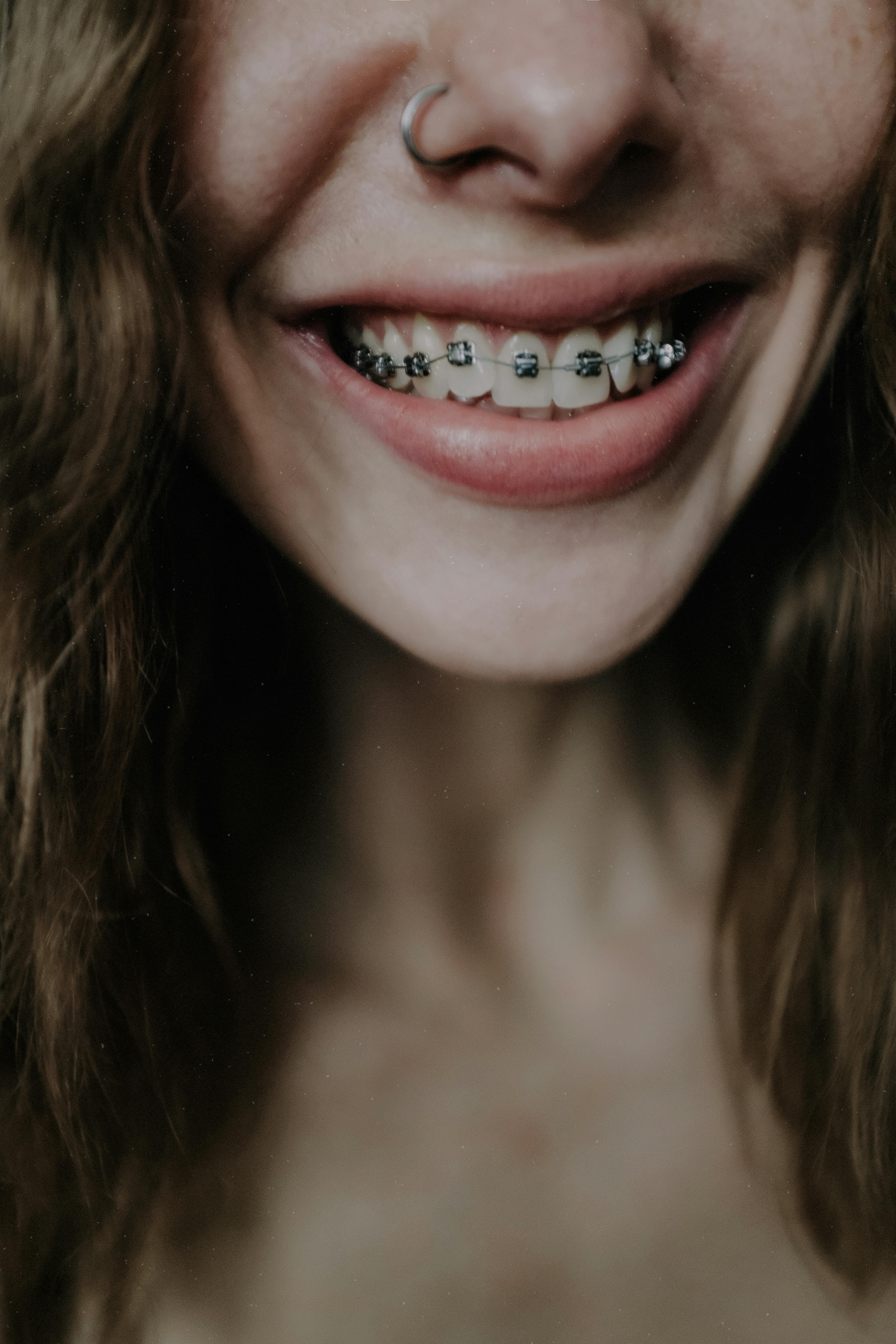 Dental Braces Gurgaon